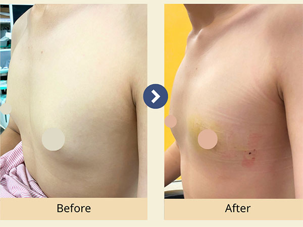 男性女乳症手術前後對照