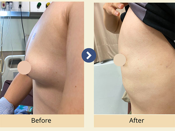 男性女乳症手術前後對照