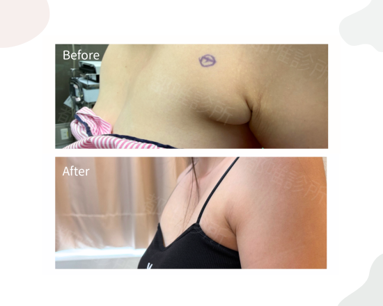 副乳案例