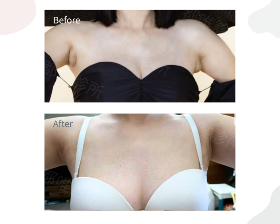 副乳案例