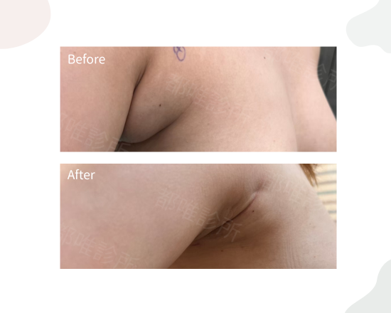 副乳改善前後・側面