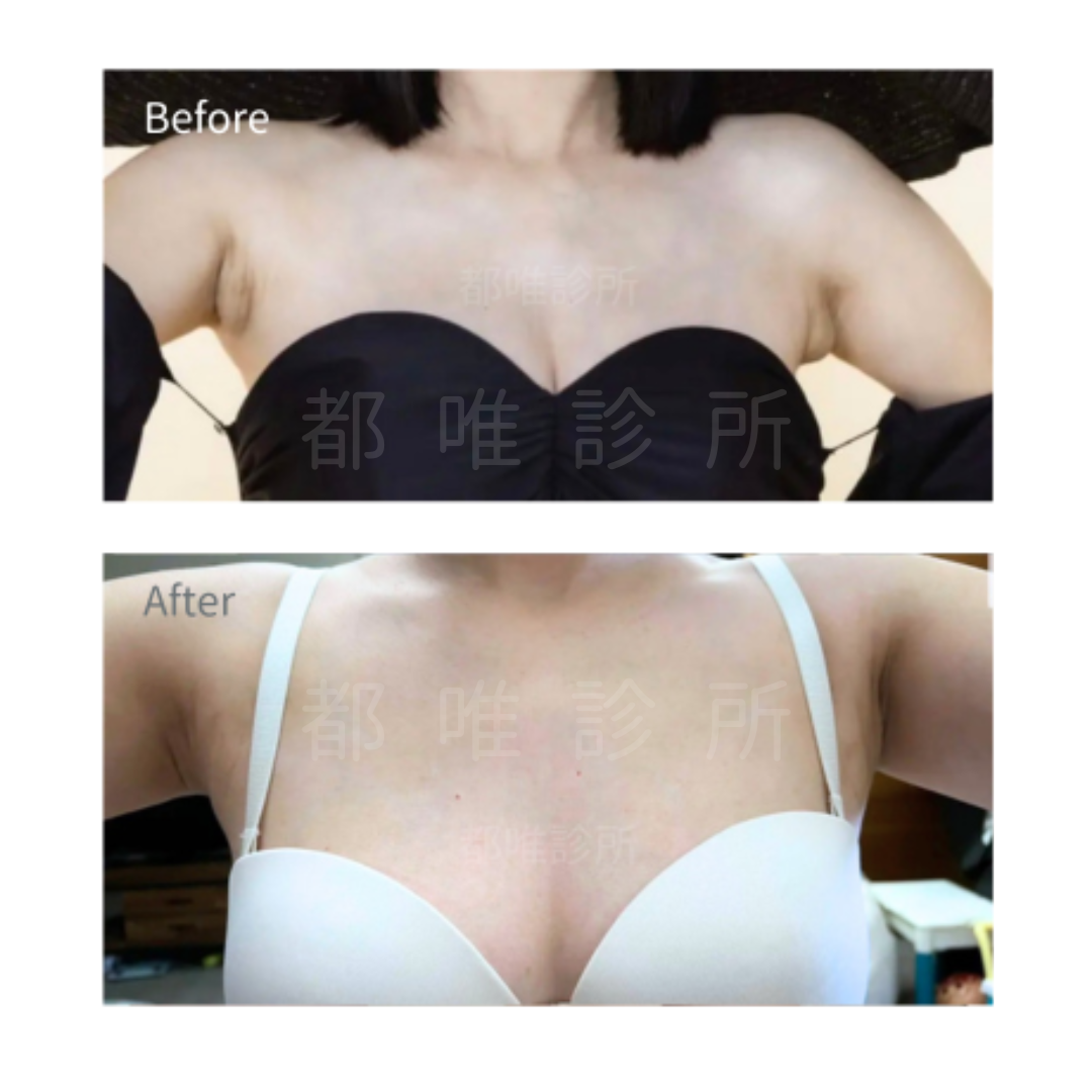 副乳改善前後・側面